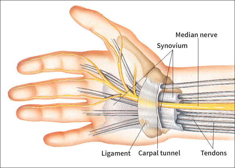 Carpal tunnel syndrome