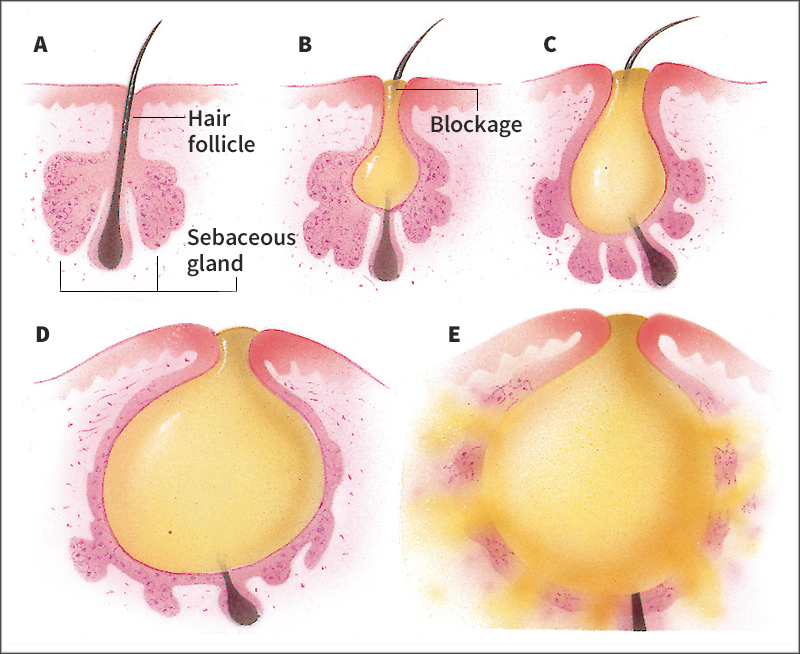 Acne pimple