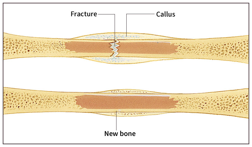 Healing of a fracture