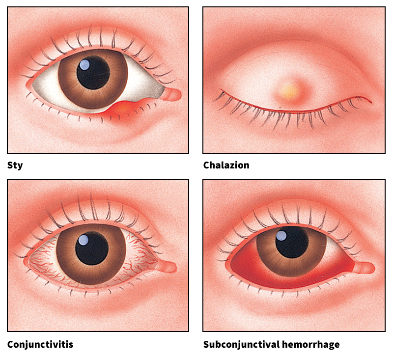 Disorders of the eye's outer parts