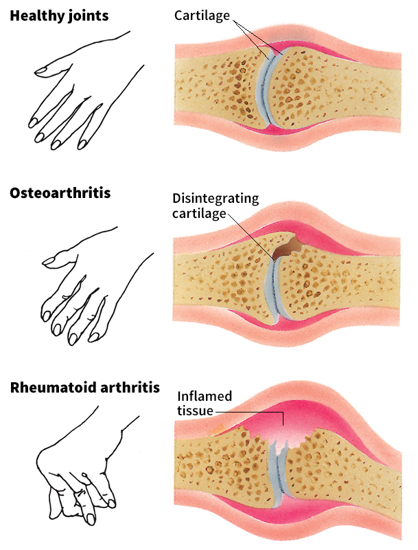 Two main types of arthritis