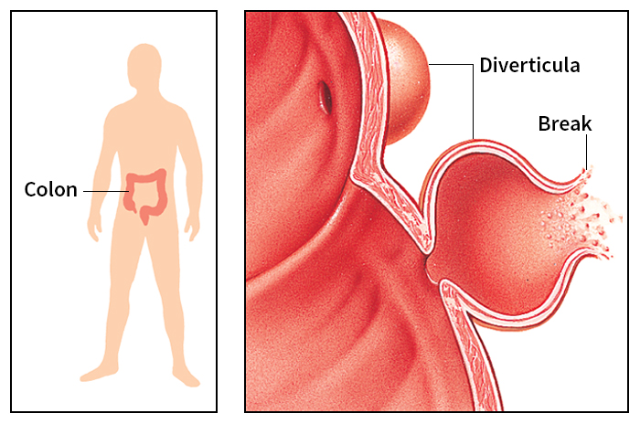 Diverticulitis