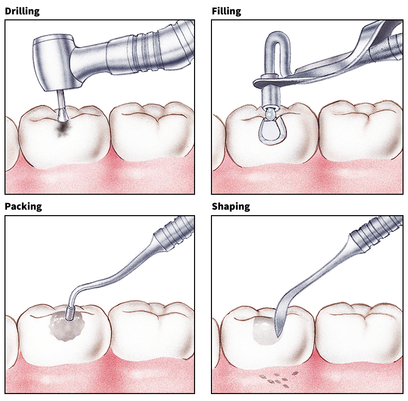 Filling a cavity