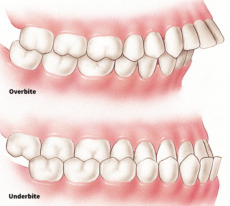 Malocclusion