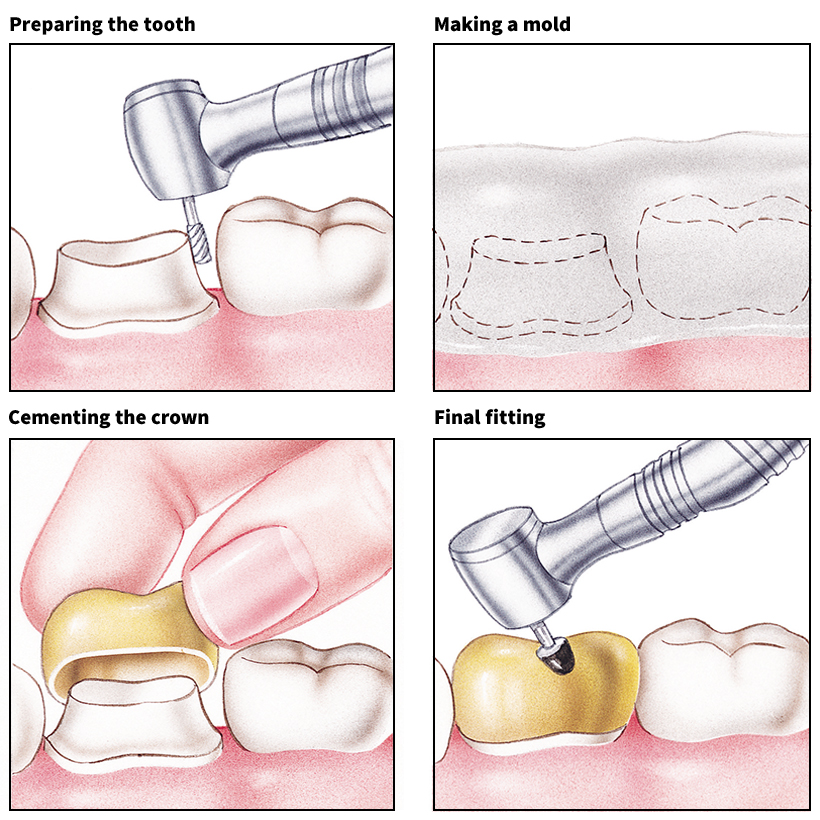 Crowning a tooth