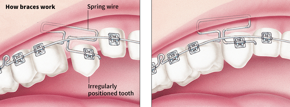 How braces work