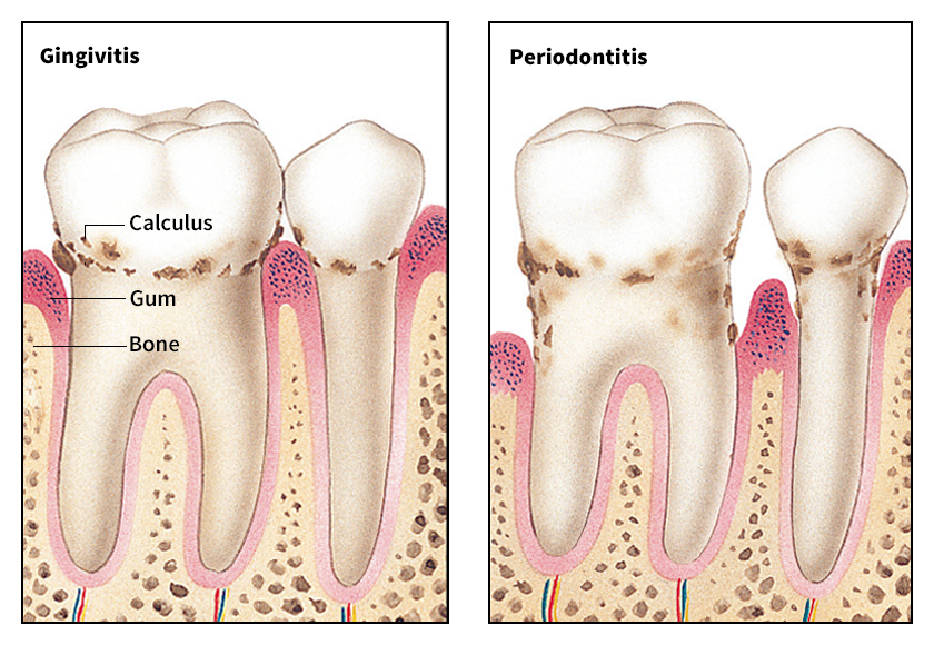 Periodontal diseases