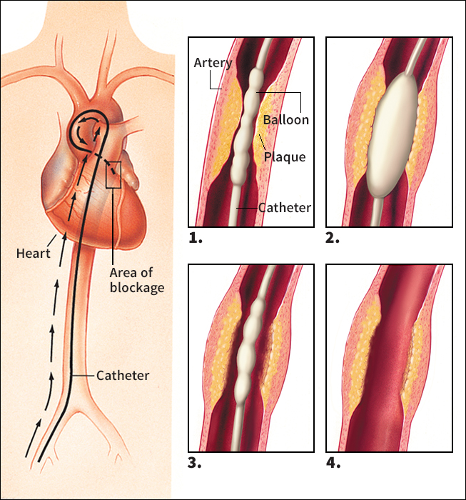 Coronary angioplasty