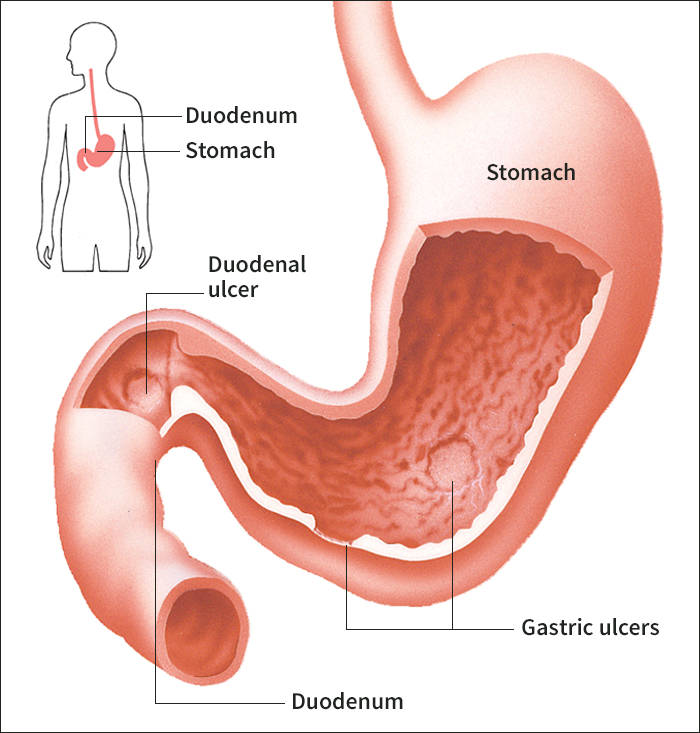 Peptic ulcers