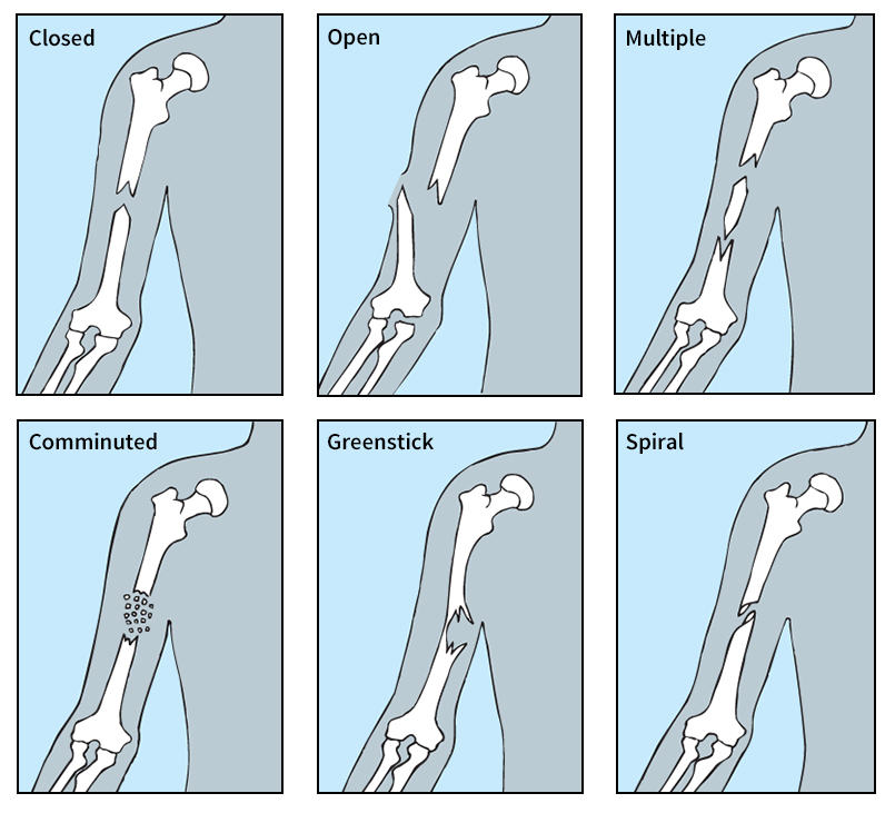 Some common kinds of fractures