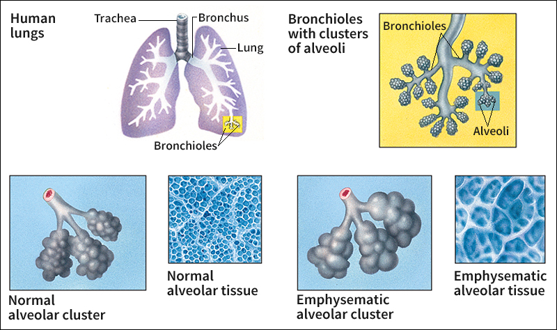 How emphysema affects the lungs