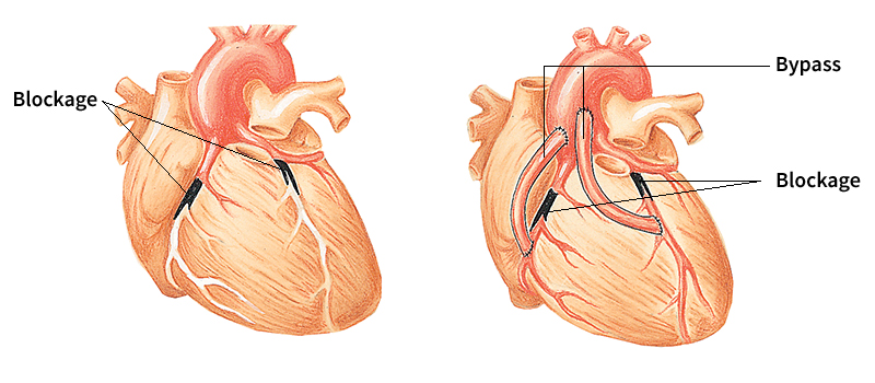 Coronary bypass surgery