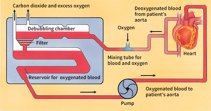 Heart-lung machine