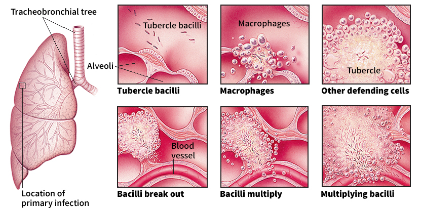 How tuberculosis develops