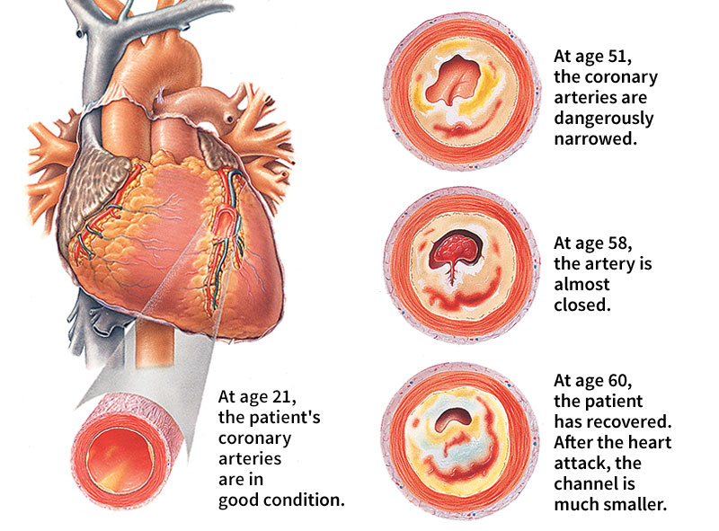 Case history of a heart attack