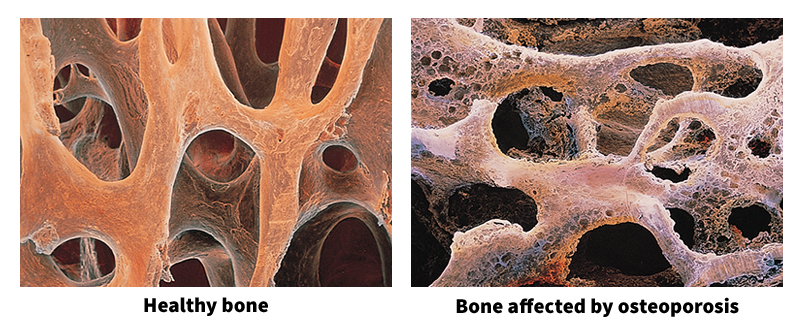 Osteoporosis