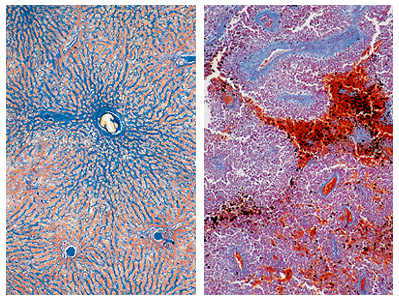 Healthy and cancerous liver cells