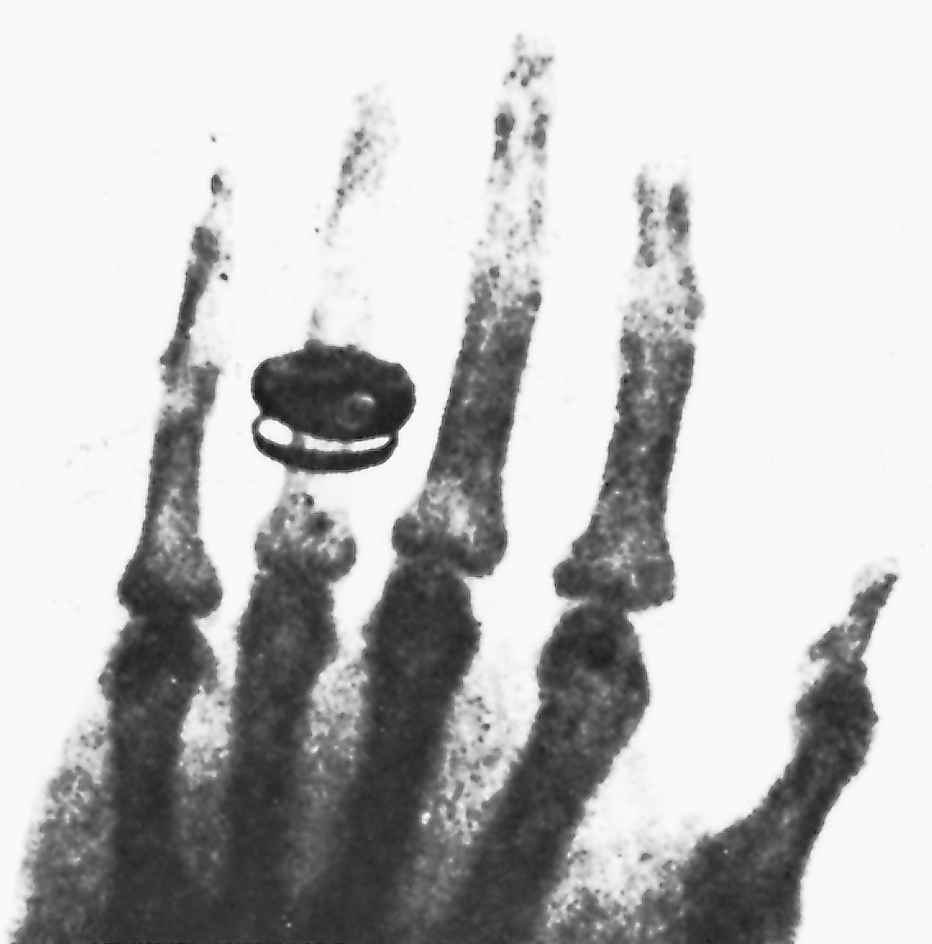 Early X ray