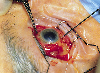 Cataract surgery