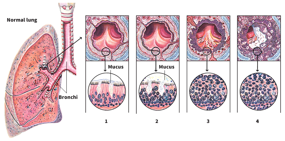 How lung cancer develops