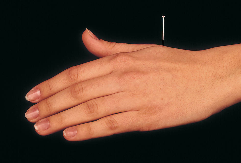 Hand with acupuncture needle