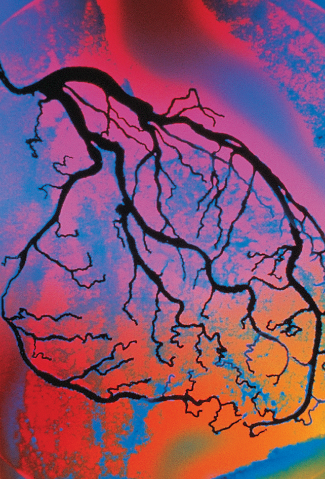 Angiogram of coronary arteries