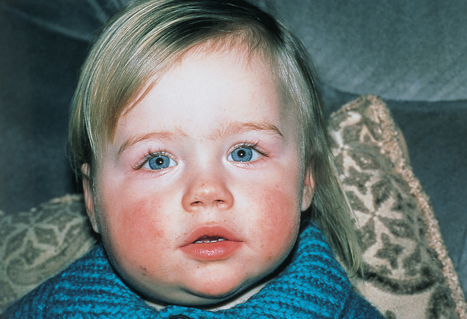 Child with the mumps