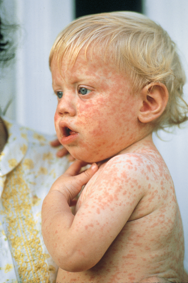 Child with the measles