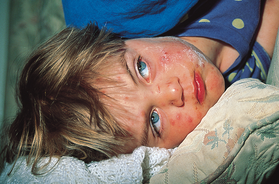 Child with chickenpox