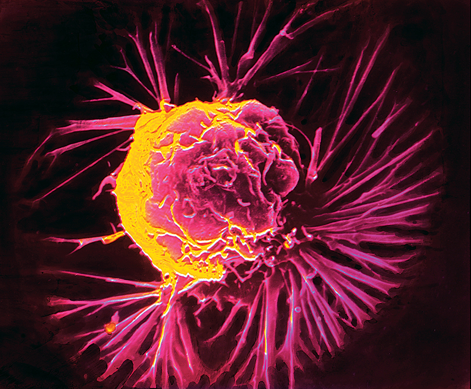 Breast cancer cell