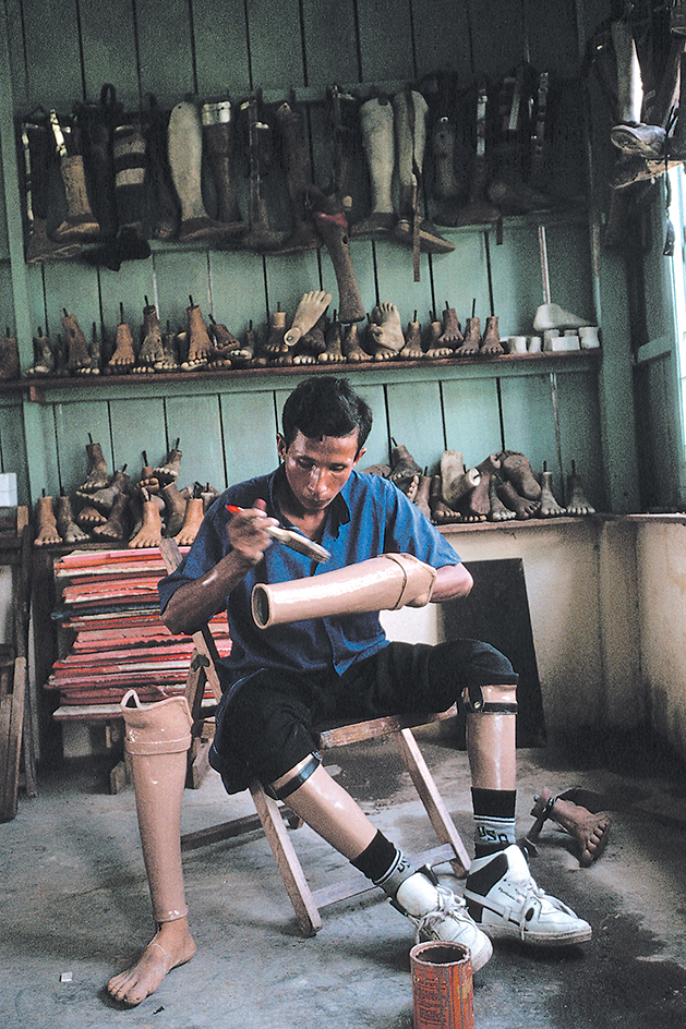 Land mine amputee working in a prosthetics clinic