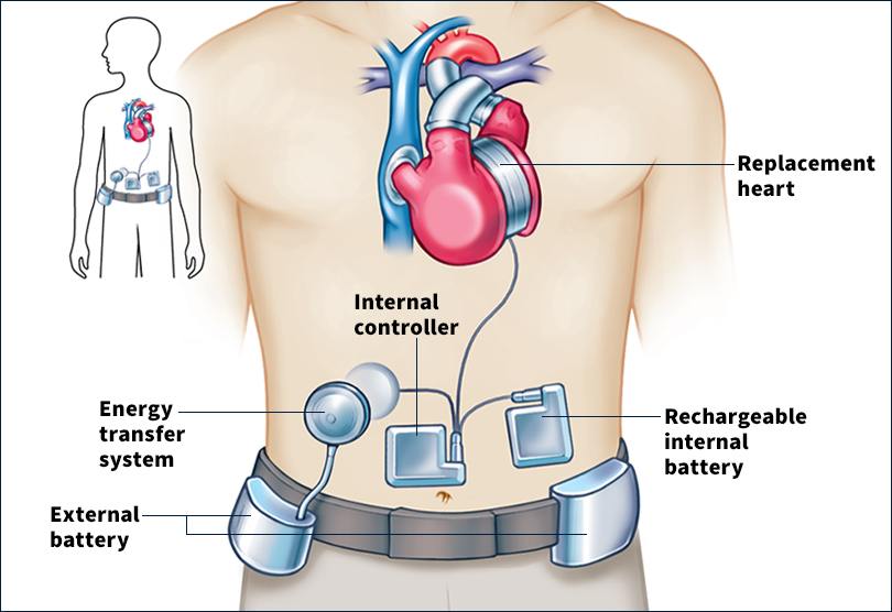 Artificial heart diagram