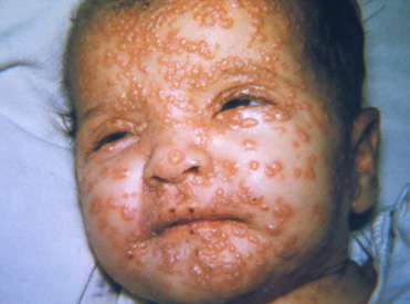 Child with smallpox