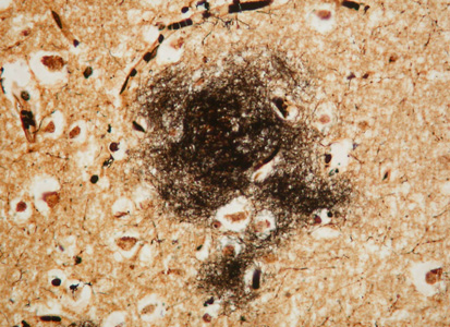 Brain tissue of Alzheimer's patient