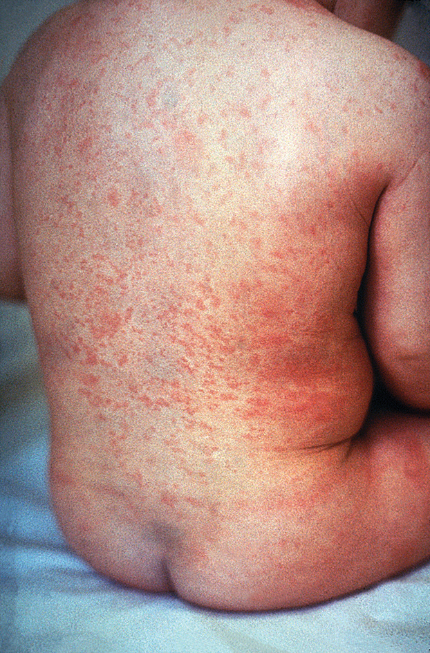 Rubella rash