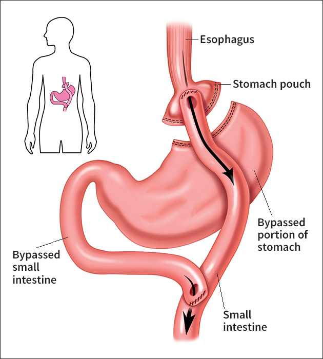 Gastric bypass operation