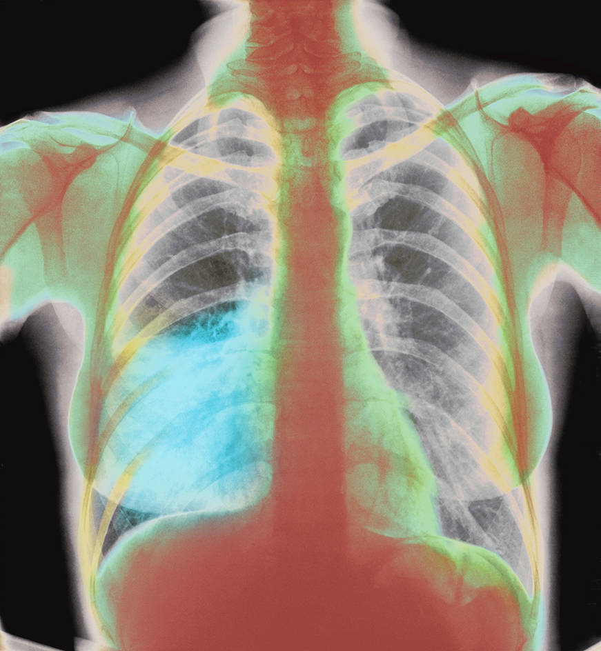 X ray of pneumonia