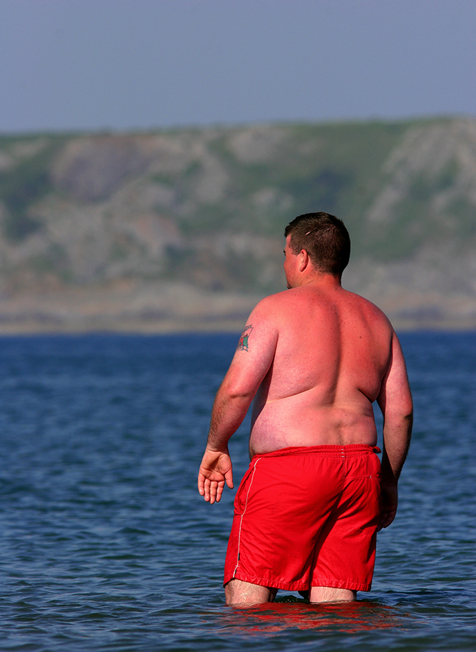 Man with sunburn