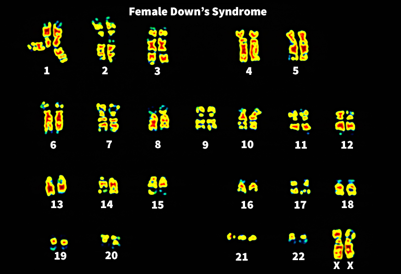 Abnormal number of chromosomes