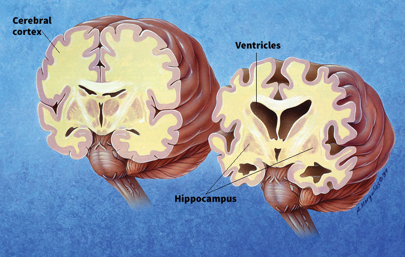 Brain with Alzheimers disease