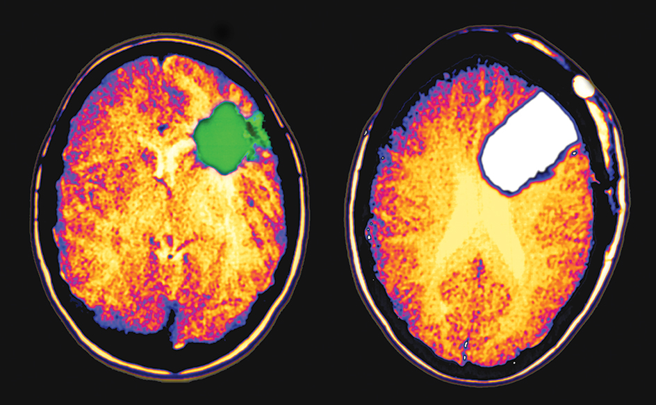 CT scans of a brain