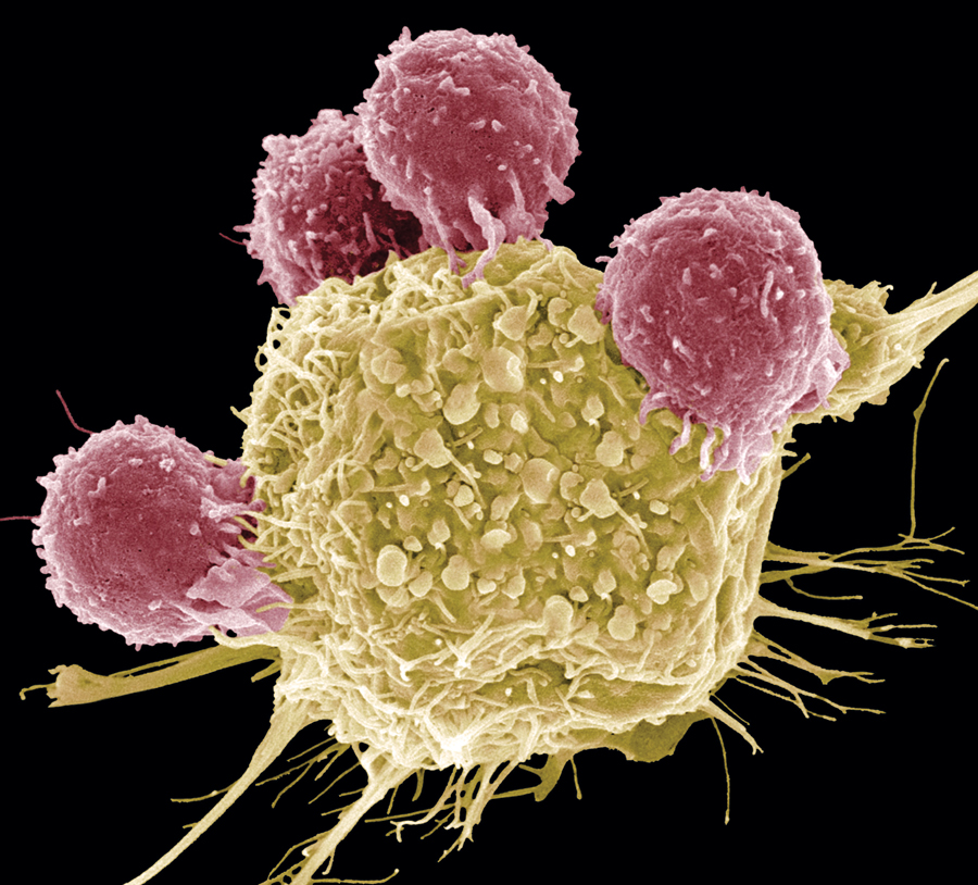 Immune system cells attack a cancer cell