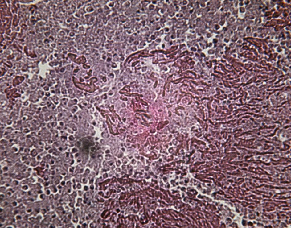 Diseased lung tissue