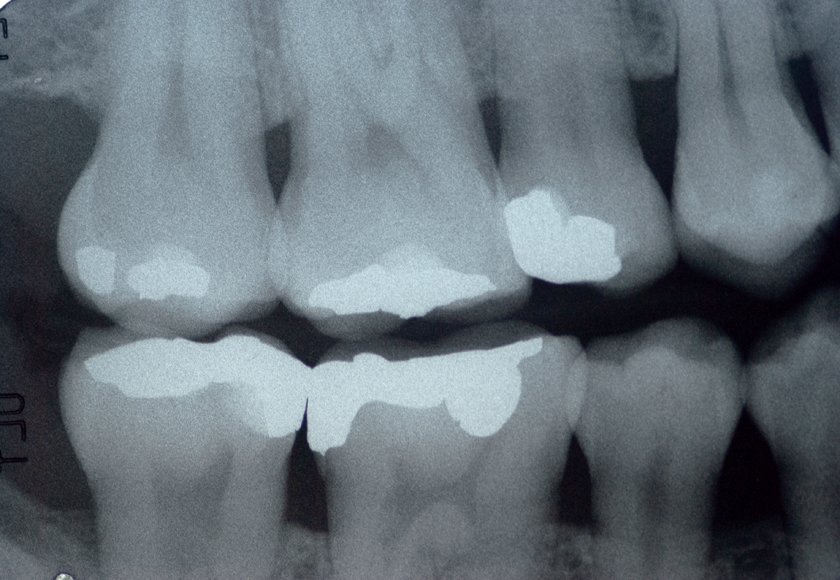 Dental X ray