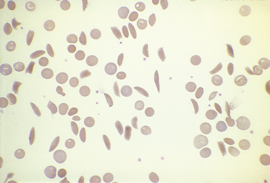 Sickle cell anemia