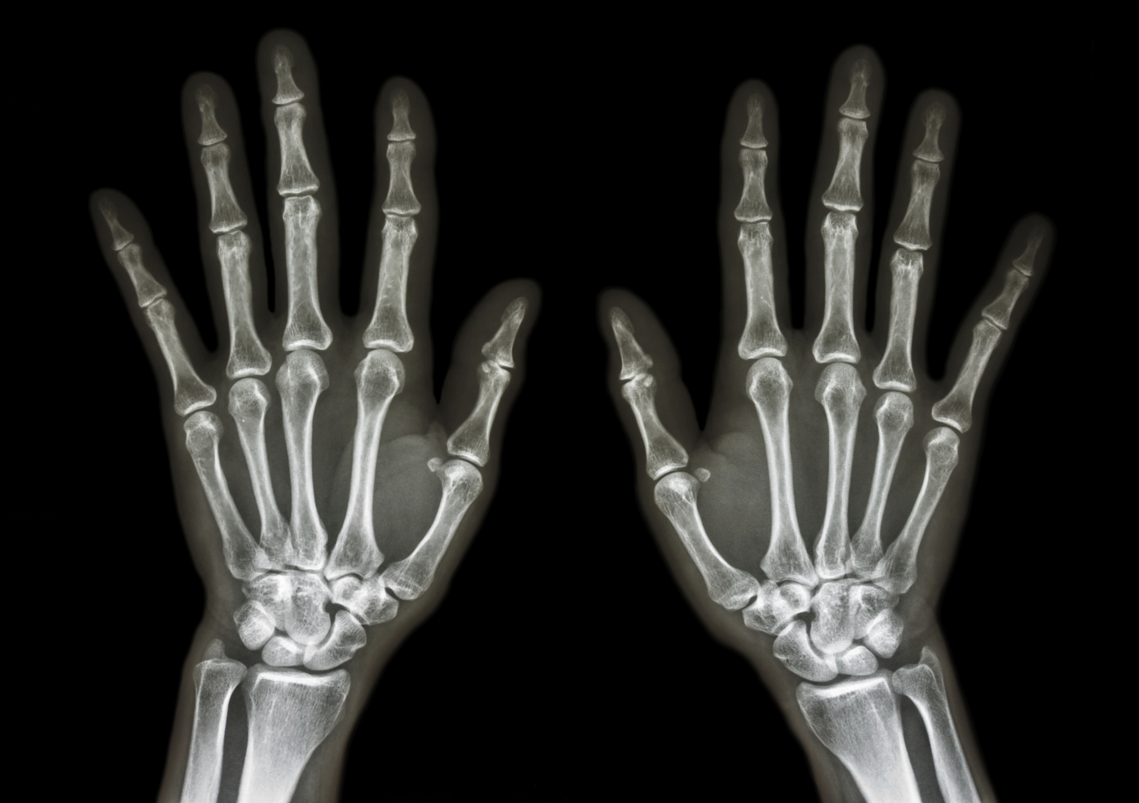 X-ray image of human hands