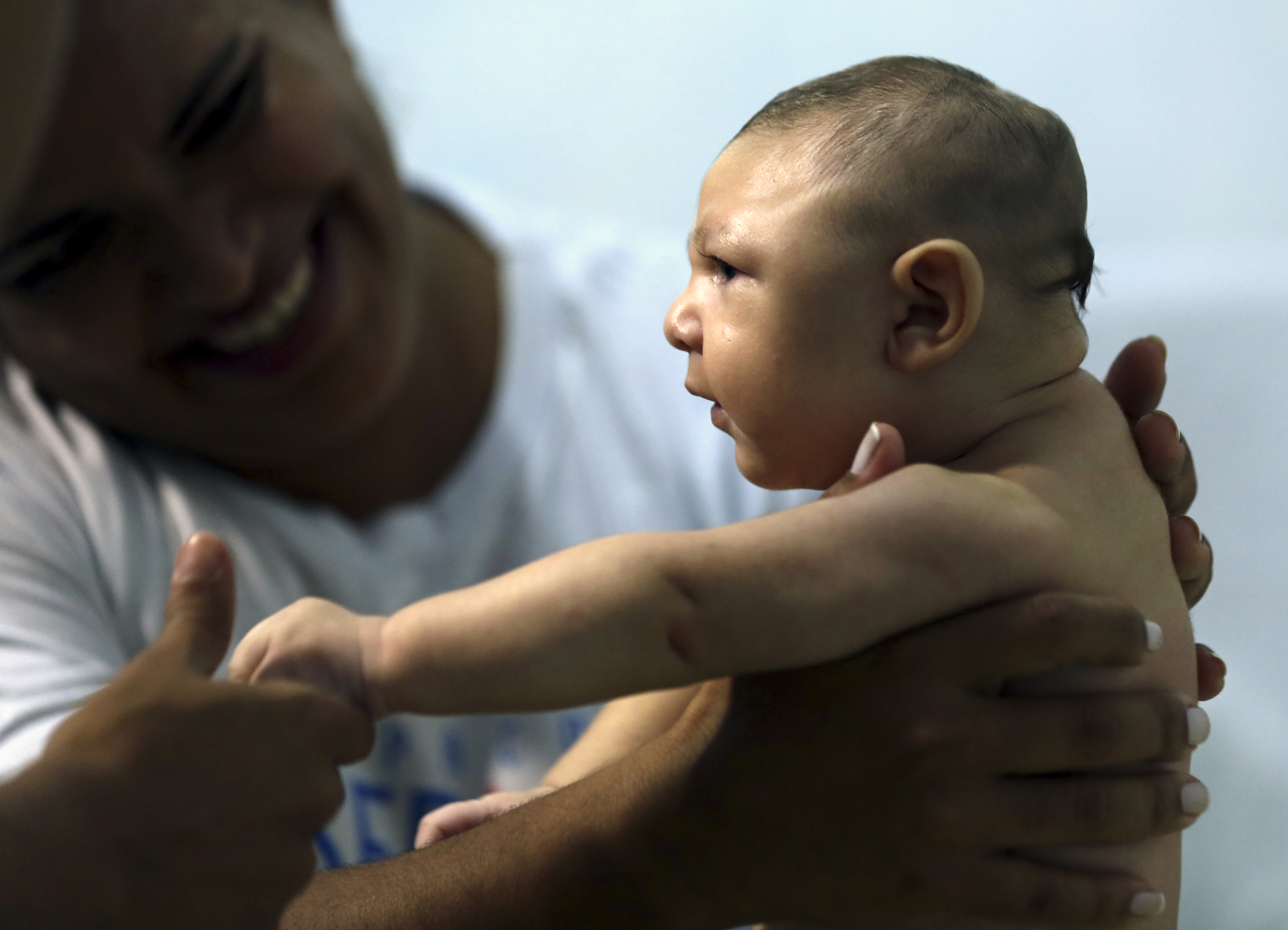 Baby with microcephaly