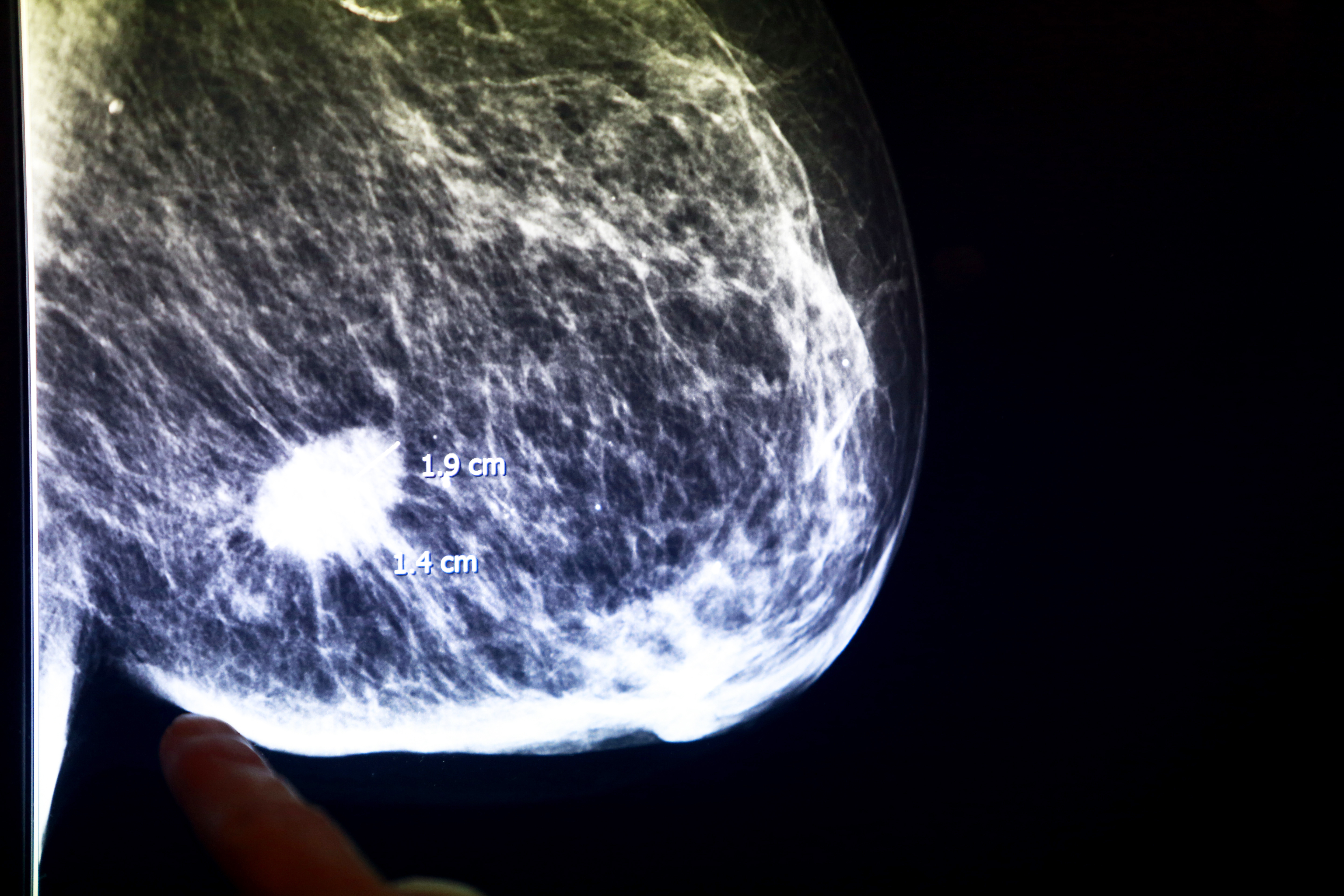 Mammogram showing breast cancer