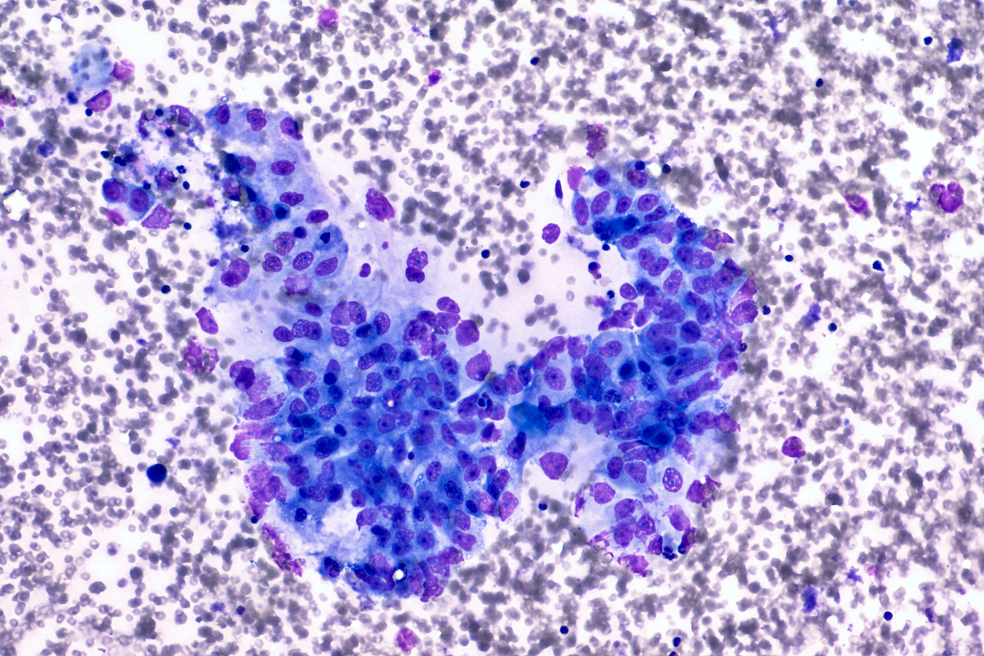 Pancreatic cancer cells