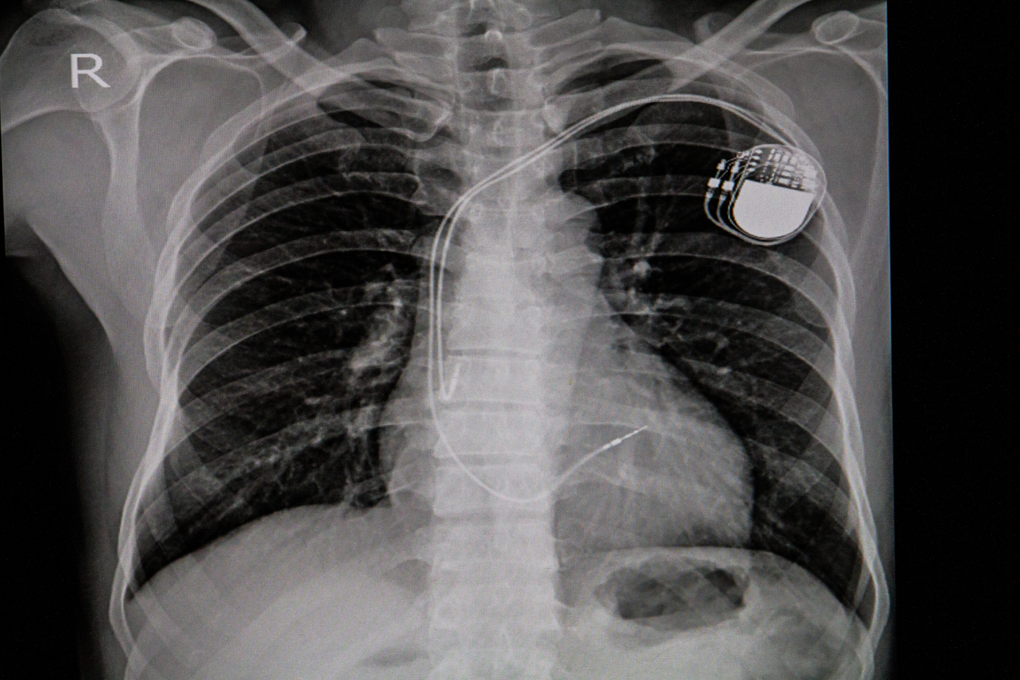 Chest x-ray showing an implanted pacemaker